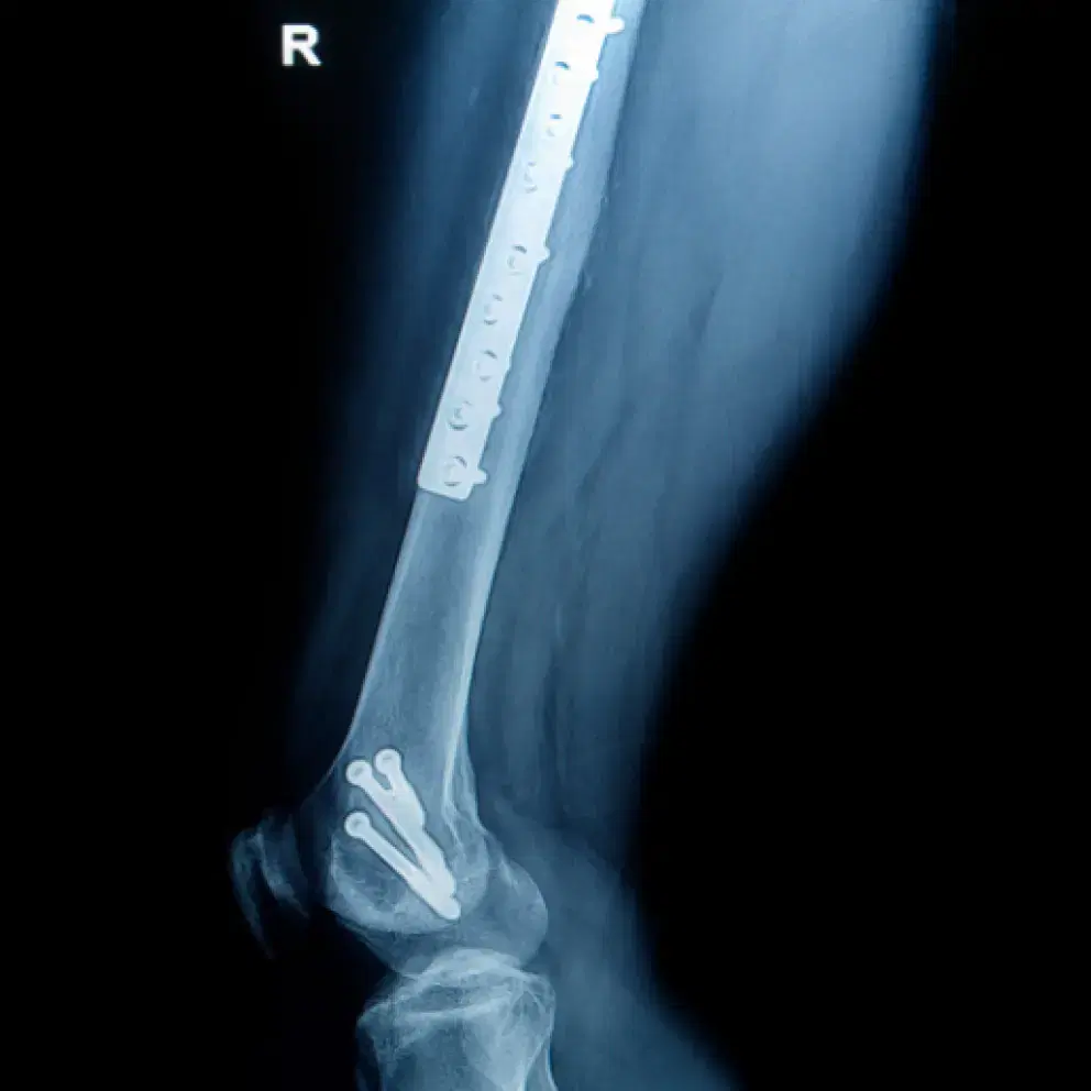 Fracture of the femur or tibia and fibula picture
