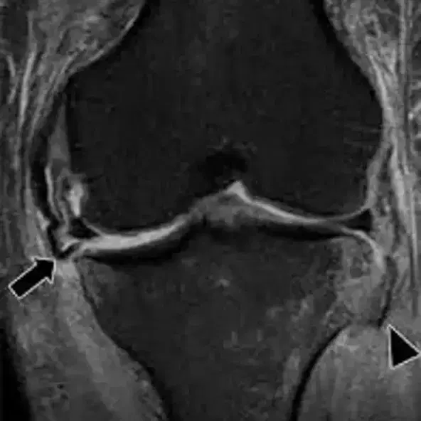 Mechanical blockage in the knee