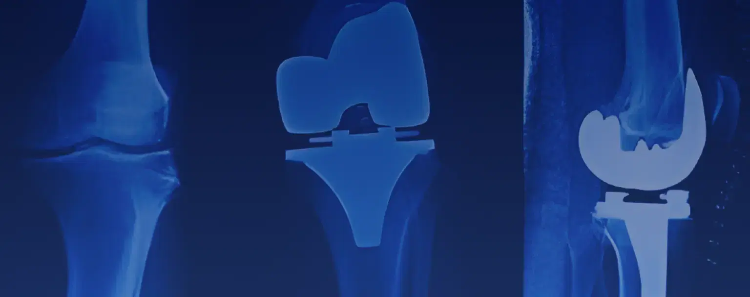 Knee Replacement background