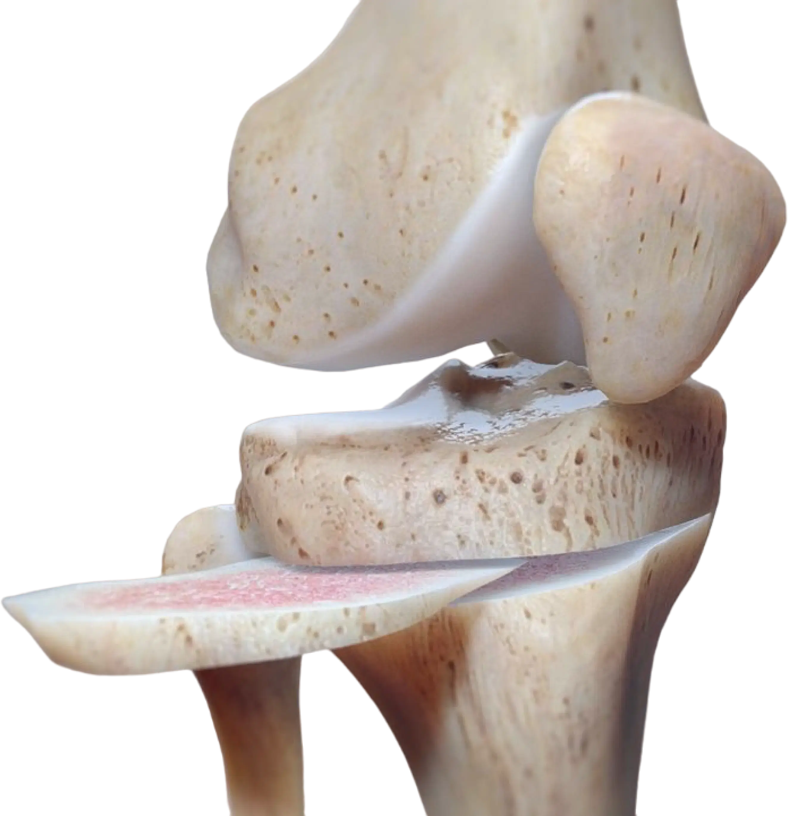 High Tibial Osteotomy