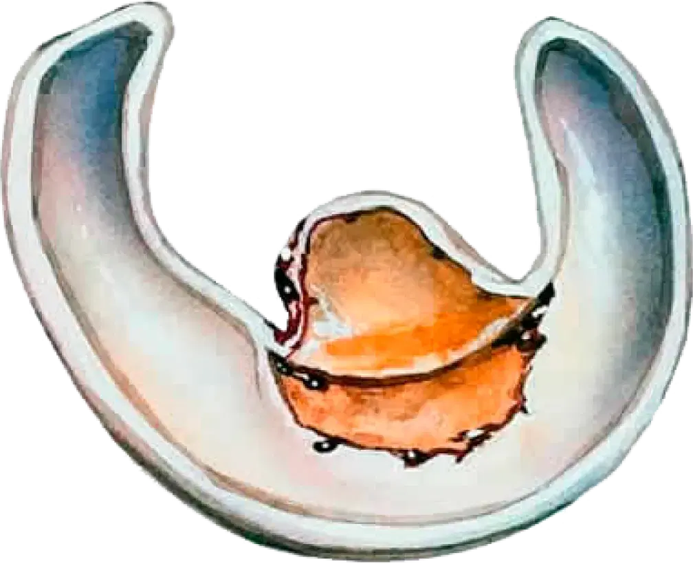 Flap tear Illustration